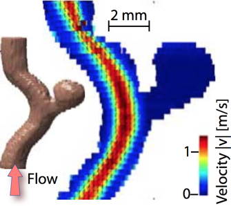The image on the right shows the results of a simple four-dimensional phase-contrast MR flow measurement